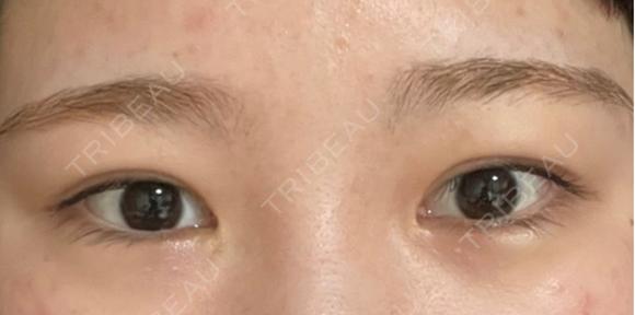 二重埋没 / タレ目形成・グラマラスライン（切開） エターナル美容クリニック BEFORE メイン用