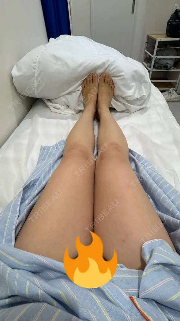 脂肪吸引（脚） アムルーズ美容外科クリニック 横浜院 BEFORE メイン用