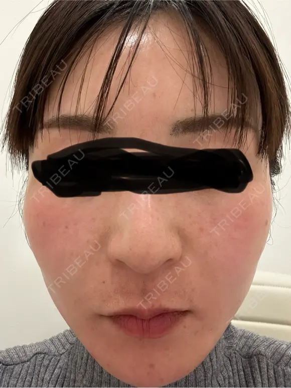 水光注射（ハリ・美肌） オラクル美容皮膚科 東京新宿院 BEFORE メイン用