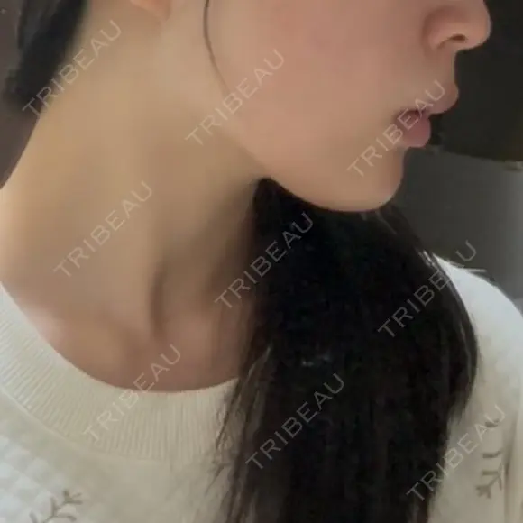 その他（輪郭） ARTE BEAUTY CLINIC BEFORE メイン用