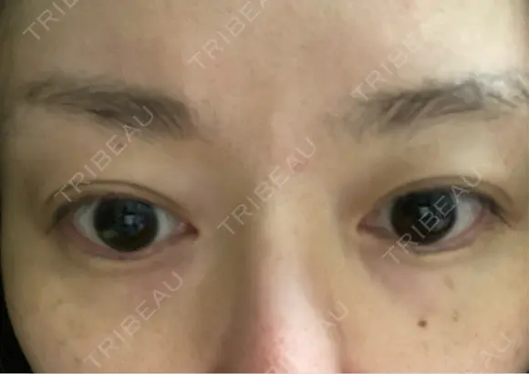 水光注射（ハリ・美肌） オラクル美容皮膚科 東京新宿院 BEFORE メイン用