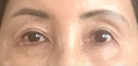 二重切開 / 眼瞼下垂（切開） / 上まぶたたるみ取り / 眉下切開 / 脂肪吸引注射（顔） / 肌ヒアルロン酸注入（たるみ・シワ改善） 東京シンデレラ美容外科 新宿院 BEFORE メイン用