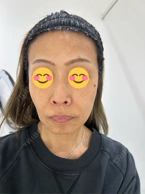 ピコレーザートーニング（美白・肝斑） / フラクショナルレーザー（毛穴・ニキビ跡） Mavie Beauty Clinic （マヴィービューティークリニック） BEFORE メイン用