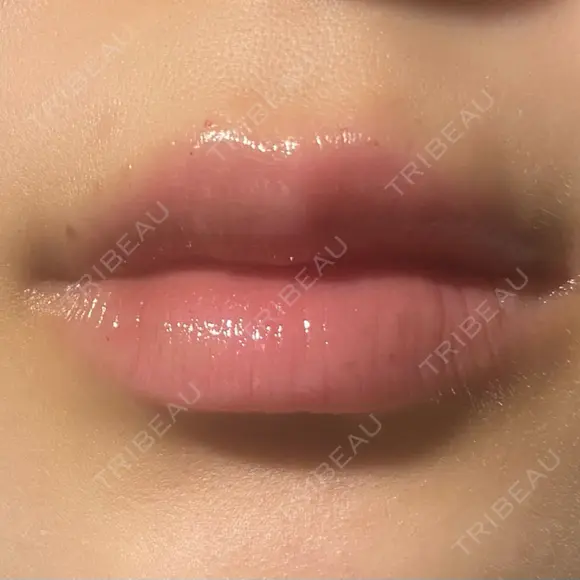 ヒアルロン酸注入（唇） 共立美容外科 大分院 BEFORE メイン用