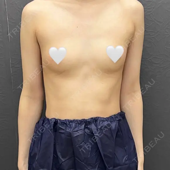 豊胸（シリコンバッグ） / 乳頭縮小 渋谷の森クリニック BEFORE メイン用