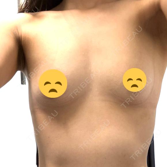 豊胸（脂肪注入） Mods Clinic（モッズクリニック） 名古屋院 BEFORE メイン用