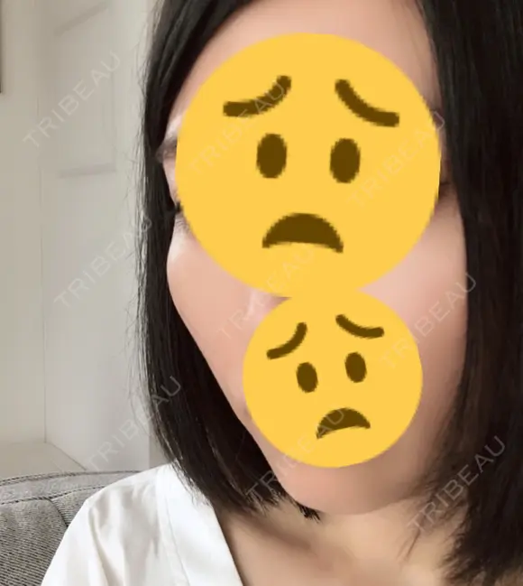 骨削り（頬） / 輪郭修正 マックスファクス銀座クリニック BEFORE メイン用
