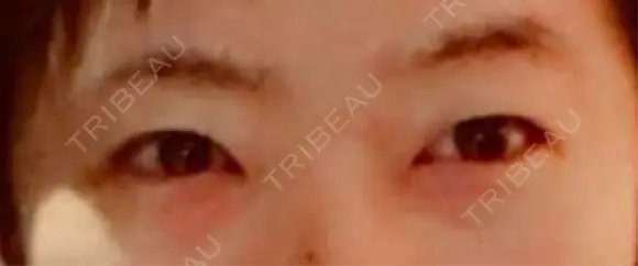 下まぶたたるみ取り / 下まぶたの脂肪取り 湘南美容クリニック 千葉センシティ院 BEFORE メイン用