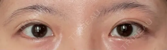 二重切開 EMMA CLINIC（エマクリニック） BEFORE メイン用