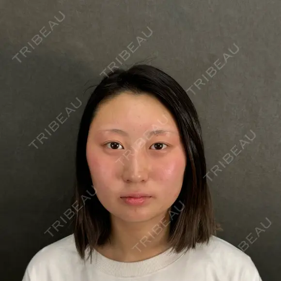 二重埋没 / 隆鼻術 / 脂肪吸引（顔） / タレ目形成・グラマラスライン（切開） / ヒアルロン酸注入（あご） ネビュラクリニック 京都院 BEFORE メイン用
