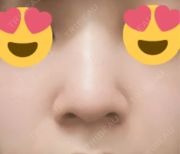 脂肪溶解注射（顔） ファイヤークリニック 銀座院 BEFORE メイン用