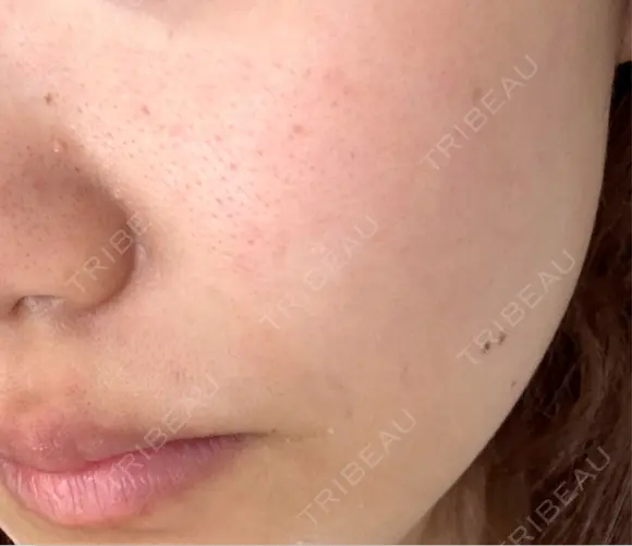 その他（肌） / 美肌レーザー こまちクリニック BEFORE メイン用