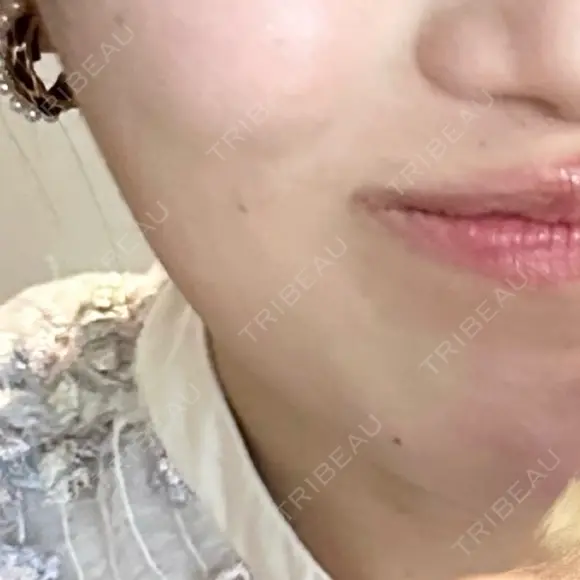 ボトックス（エラ・小顔） 共立美容外科 大阪本院 BEFORE メイン用