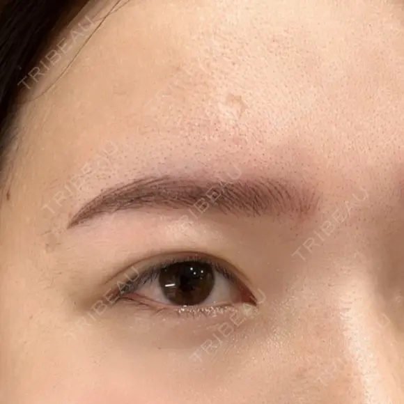 眉下切開 Barbie Clinic BEFORE メイン用