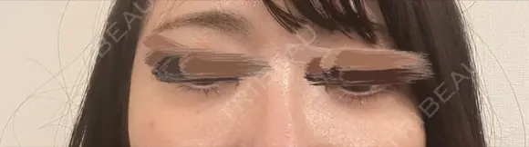 ヒアルロン酸注入（涙袋） / ヒアルロン酸注入（目の下） ファイヤークリニック 渋谷院 BEFORE メイン用