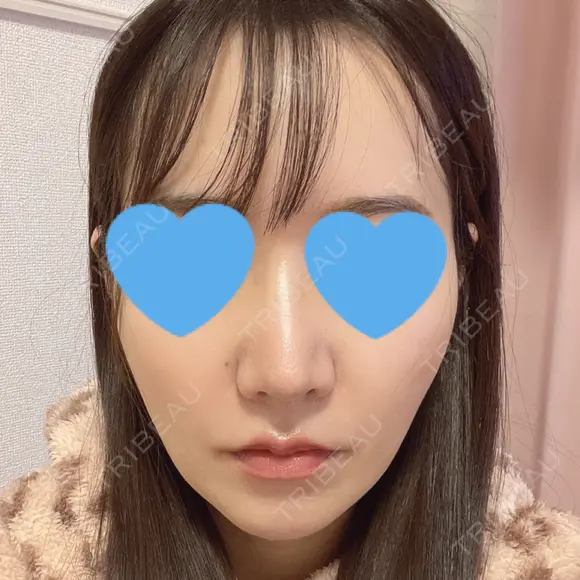 鼻尖形成（切開） / 小鼻縮小（切開） / ワシ鼻修正・ハンプ切除 / 鼻柱下降・鼻唇角形成（猫手術） ASTRA BEAUTY CLINIC BEFORE メイン用