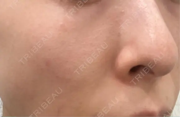 ミラノリピール ミニマムスキンクリニック池袋 BEFORE メイン用