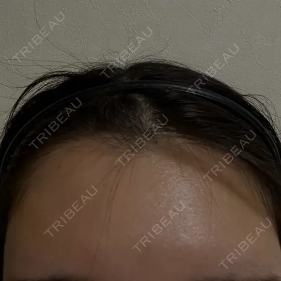 ヒアルロン酸注入（額） / ボトックス（眉間） PRO CLINIC プロクリニック 銀座院 BEFORE メイン用