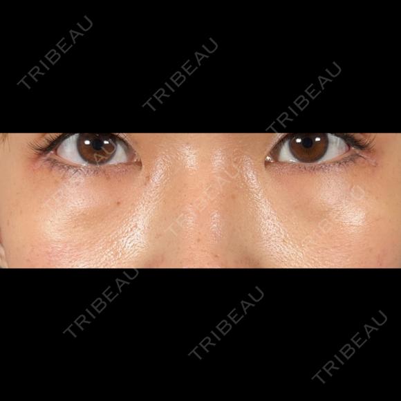 クマ治療 R Beauty CLINIC 名古屋院 BEFORE メイン用