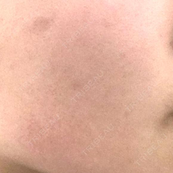 ルメッカ ルラ美容クリニック銀座院 BEFORE メイン用