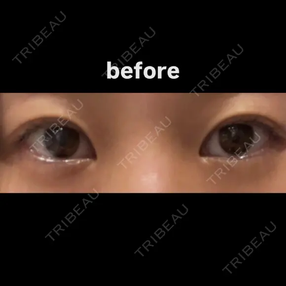 目尻切開 こまちクリニック BEFORE メイン用
