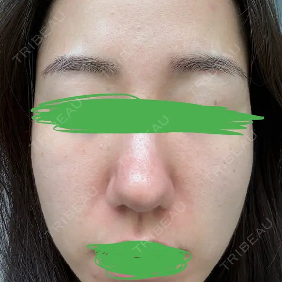 ピコレーザートーニング（美白・肝斑） / ピコフラクショナルレーザー（毛穴・ニキビ跡） おおかみ美容のクリニック 新宿院 BEFORE メイン用