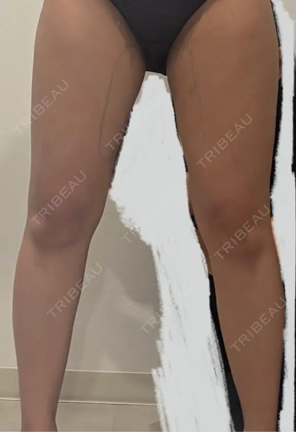 医療痩身（太もも） / 脂肪冷却（太もも） DSクリニック 新宿院 BEFORE メイン用