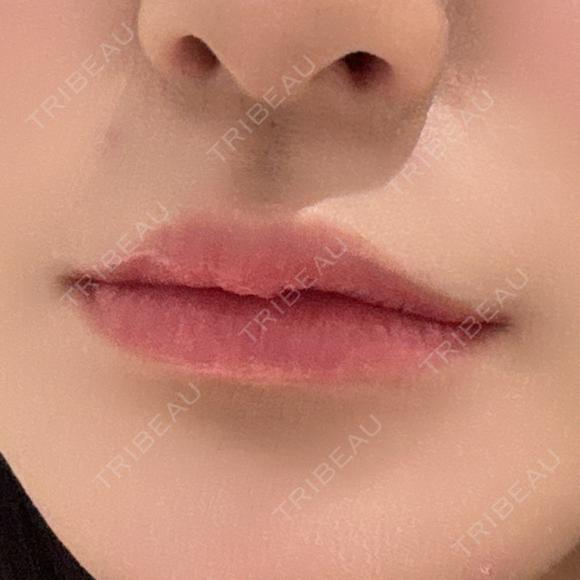 ヒアルロン酸注入（唇） R Beauty CLINIC 銀座院 BEFORE メイン用