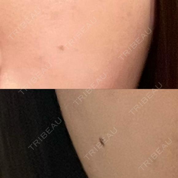 ほくろ・いぼ切除（肌） Belle Via Skin Clinic BEFORE メイン用