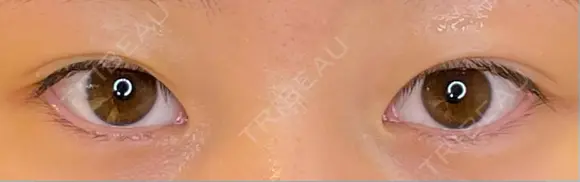 目尻切開 / タレ目形成・グラマラスライン（埋没） LOUIS CLINIC 二子玉川院【ルイクリニック】 BEFORE メイン用