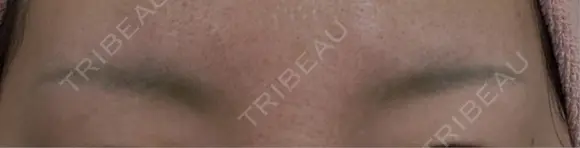 アートメイク除去・修正 渋谷美容外科クリニック 新宿院 BEFORE メイン用