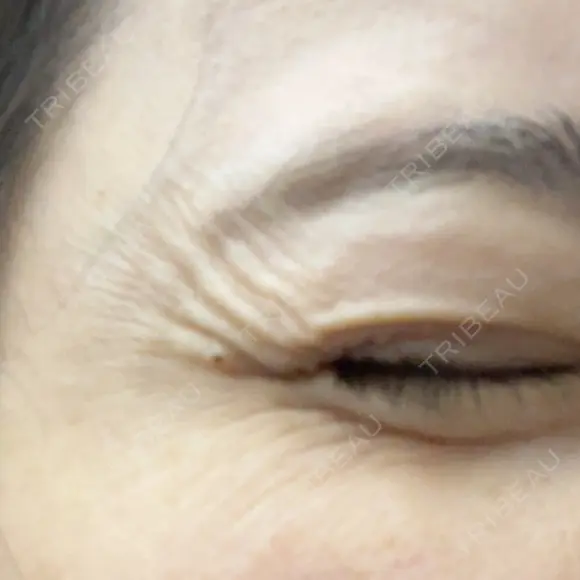 ボトックス（目尻） PRO CLINIC プロクリニック 銀座院 BEFORE メイン用