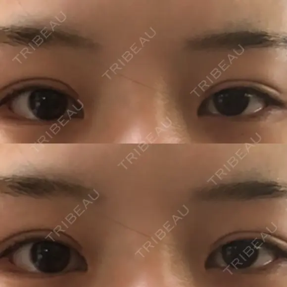 ボトックス（タレ目） 新宿ラクル美容外科クリニック 新宿院 BEFORE メイン用