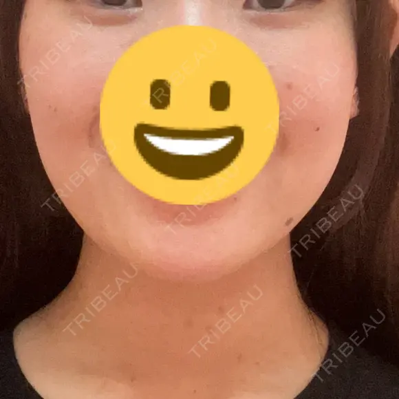 アートメイク（ほくろ） 美容皮膚科エルムクリニック 福岡院 BEFORE メイン用