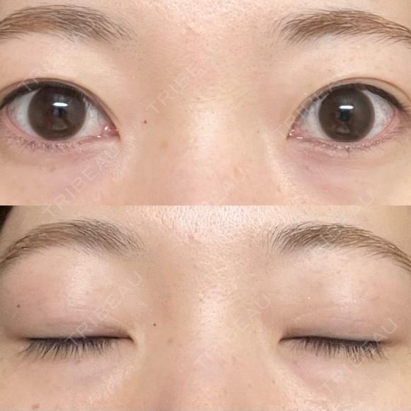 二重埋没 / 目頭切開 アリエル美容クリニック 郡山院 BEFORE メイン用