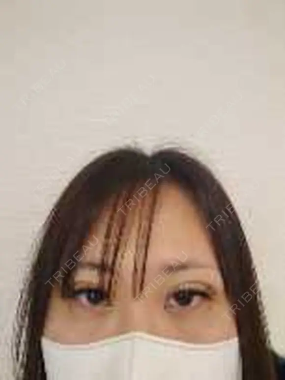 二重埋没 THE FIRST CLINIC 多摩センター院 BEFORE メイン用