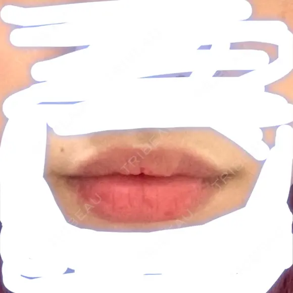 口唇縮小術 / PRP皮膚再生療法 品川スキンクリニック福岡院 BEFORE メイン用