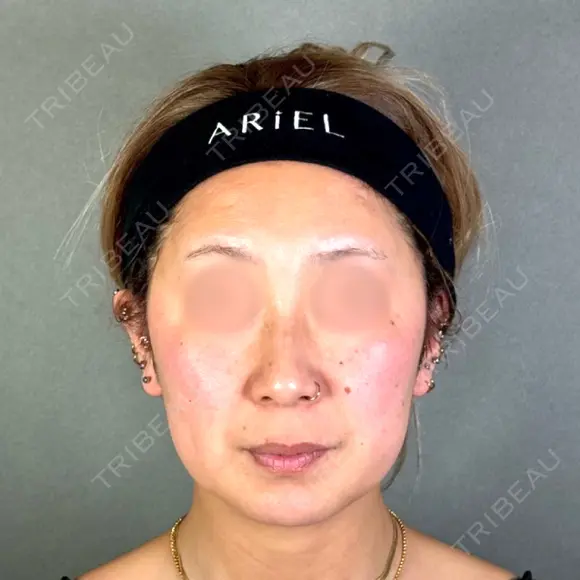糸リフト / 脂肪吸引（顔） / ジョールファット除去 アリエル美容クリニック 郡山院 BEFORE メイン用