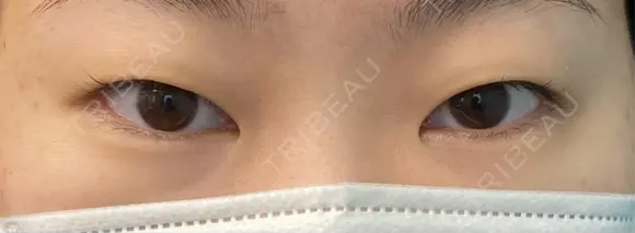二重埋没 湘南美容クリニック 千葉センシティ院 BEFORE メイン用