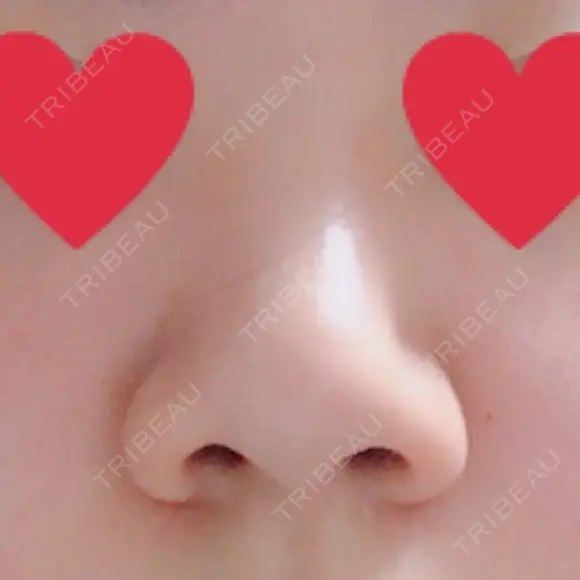 小鼻縮小（切開） ヴェリィ美容形成クリニック BEFORE メイン用