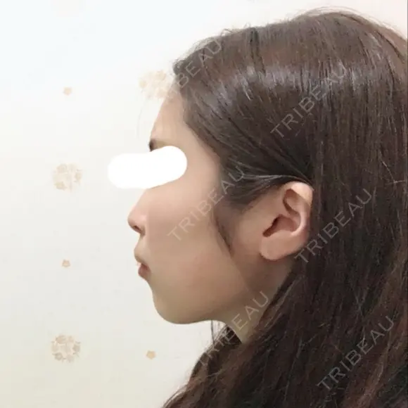 脂肪注入（輪郭） / 再生医療 / PRP皮膚再生療法 チョンダムオラクル皮膚科整形外科医院 BEFORE メイン用