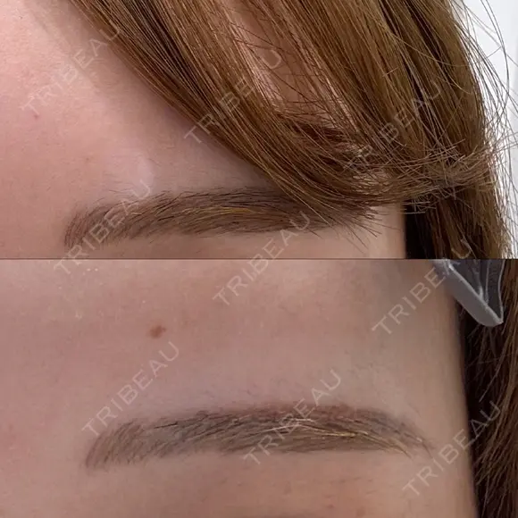 ヒアルロン酸注入（涙袋） / アートメイク除去・修正 渋谷美容外科クリニック 新宿院 BEFORE メイン用