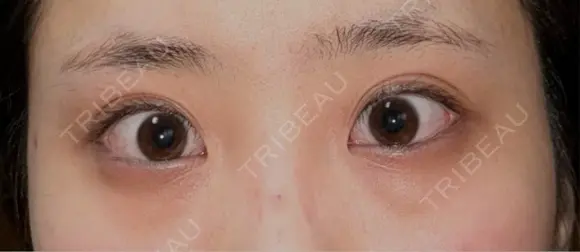 下まぶたの脂肪取り / タレ目形成・グラマラスライン（切開） / 目尻靭帯移動 池袋麗歯科・美容皮膚科 BEFORE メイン用