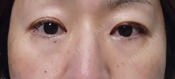 下まぶたたるみ取り / 下まぶたの脂肪取り / 脂肪注入（目の下） 湘南美容クリニック 千葉センシティ院 BEFORE メイン用