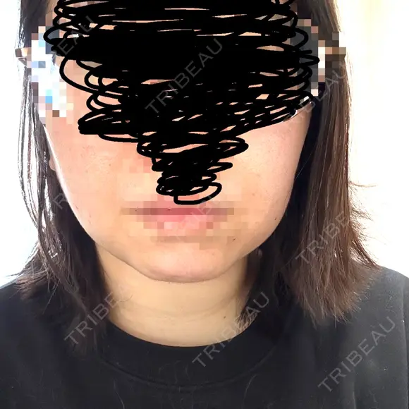 RF（高周波）たるみ治療 大美会クリニック 心斎橋本院 BEFORE メイン用