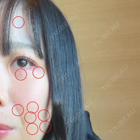 ほくろ・いぼ切除（肌） KARIS beauty clinic BEFORE メイン用