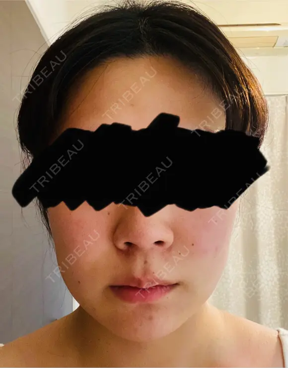 脂肪吸引（顔） / 脂肪吸引（二の腕） Mods Clinic（モッズクリニック） 福岡院 BEFORE メイン用