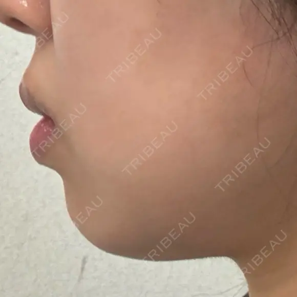 ボトックス（あご） / ボトックス（ふくらはぎ） / ボトックス（太もも） DMTC CLINIC 日本橋院 BEFORE メイン用