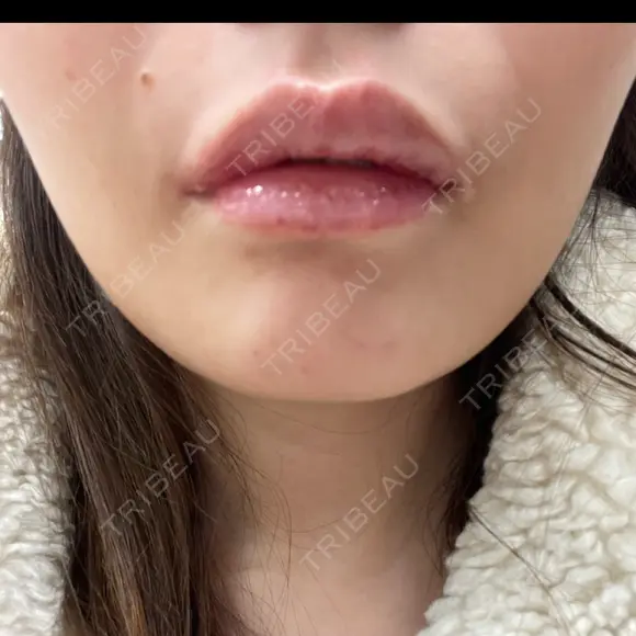 ボトックス（あご） / ボトックス（エラ・小顔） / ヒアルロン酸注入（唇） / ボトックス（眉間） / ボトックス（人中） 上野美容外科・美容皮膚科 BEFORE メイン用