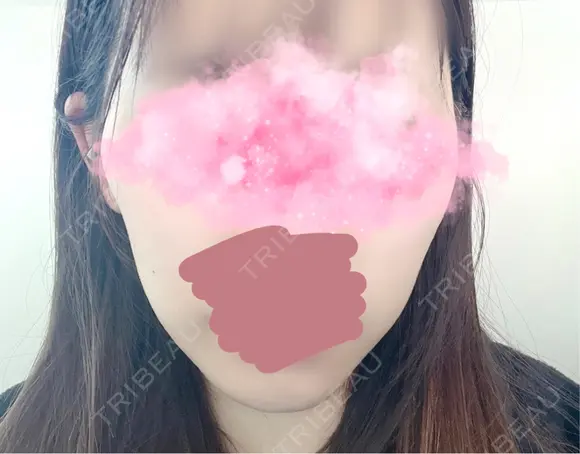 糸リフト / 肌ヒアルロン酸注入（たるみ・シワ改善） 上野美容外科・美容皮膚科 BEFORE メイン用